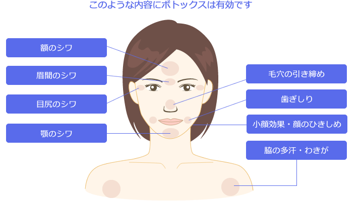 このような内容にボトックスは有効です