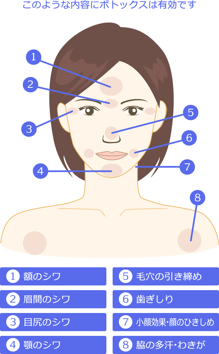 このような内容にボトックスは有効です