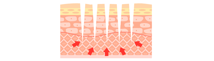 ダーマペン4の治療の仕組みのイメージ