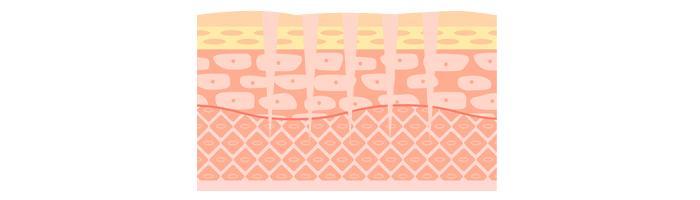 ダーマペン4の治療の仕組みのイメージ