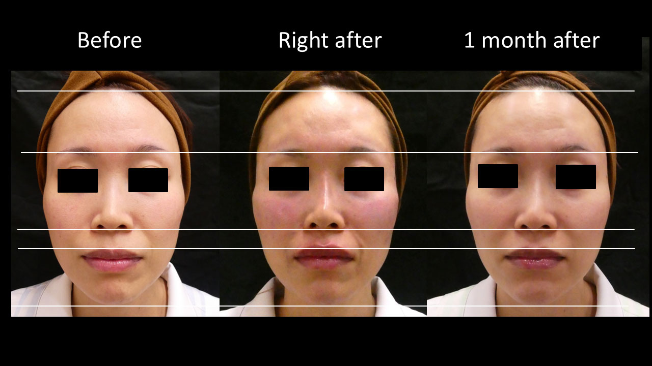 30代女性の症例写真4