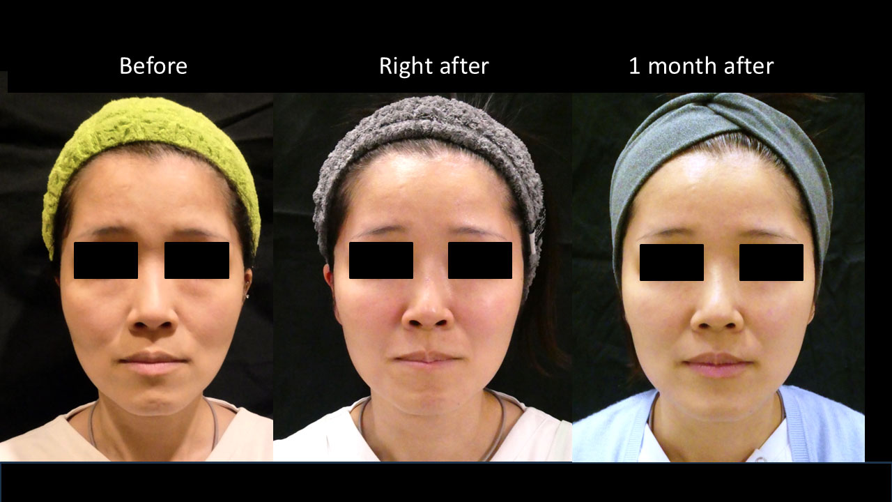 30代女性の症例写真3