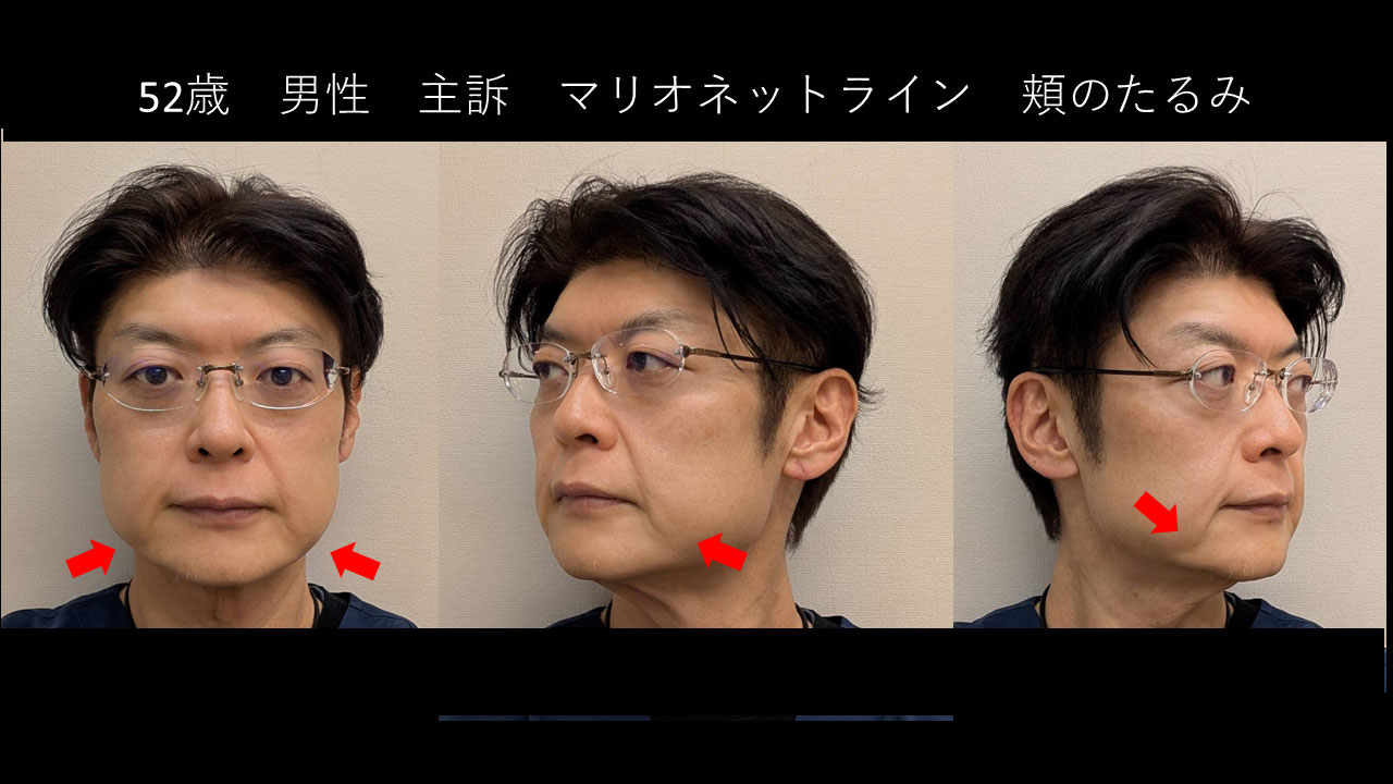52歳男性医師の症例写真1