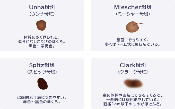 ほくろの種類の図