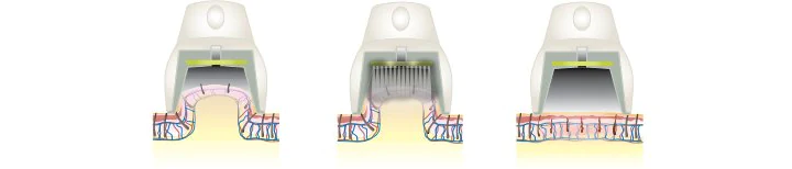 ライトシュアデュエットの照射時における吸引イメージイラスト図