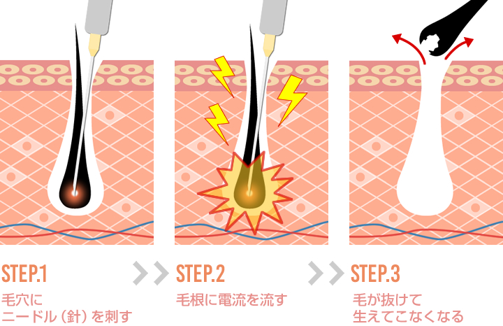 ニードル脱毛（針脱毛）の仕組み