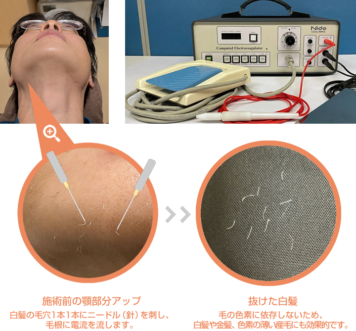 ニードル脱毛（針脱毛）の施術例