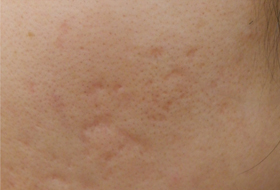 ニキビ跡治療キュアジェットの症例写真