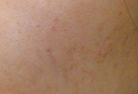 ニキビ跡治療キュアジェットの症例写真