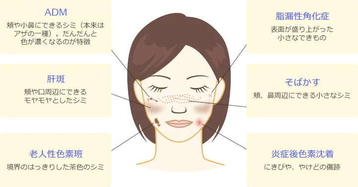 シミの種類【ADMー頬や小鼻にできるシミ（本来はアザの一種）。だんだんと色が濃くなるのが特徴】【肝斑ー頬や口周辺にできるモヤモヤとしたシミ】【老人性色素班ー境界のはっきりした茶色のシミ】【脂漏性角化症ー表面が盛り上がった小さなできもの】【そばかすー頬、鼻周辺にできる小さなシミ】【炎症後色素沈着ーにきびや、やけどの傷跡】